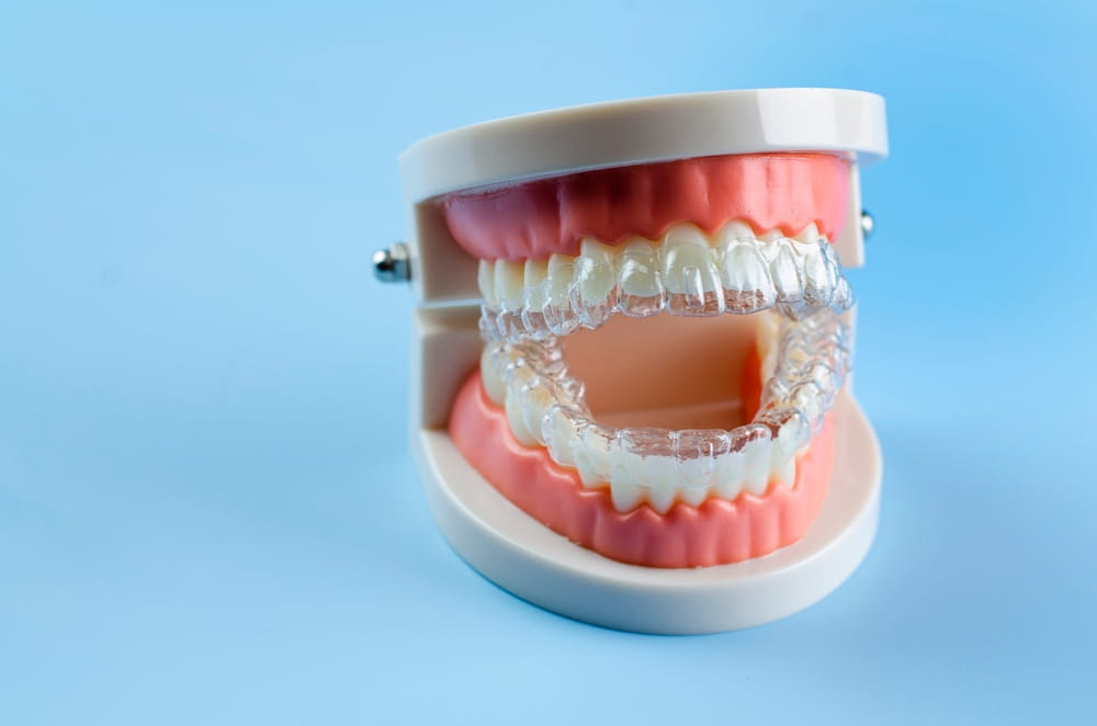 Des gouttières invisibles d'orthodontie placées sur un modèle dentaire