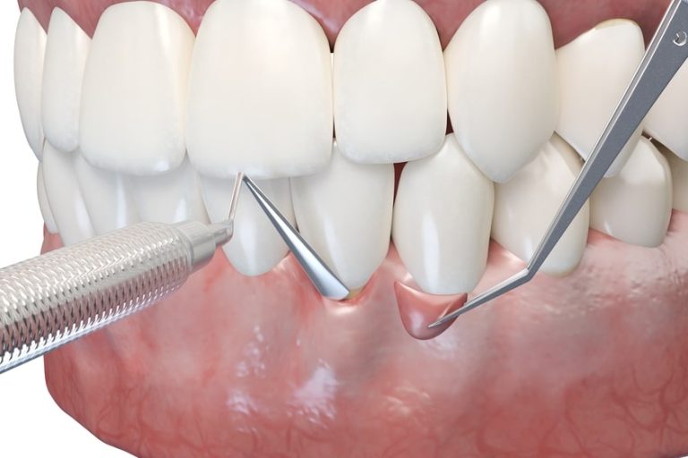 Illustration 3D montrant une greffe de gencive, avec un greffon apposé sur le site chirurgical