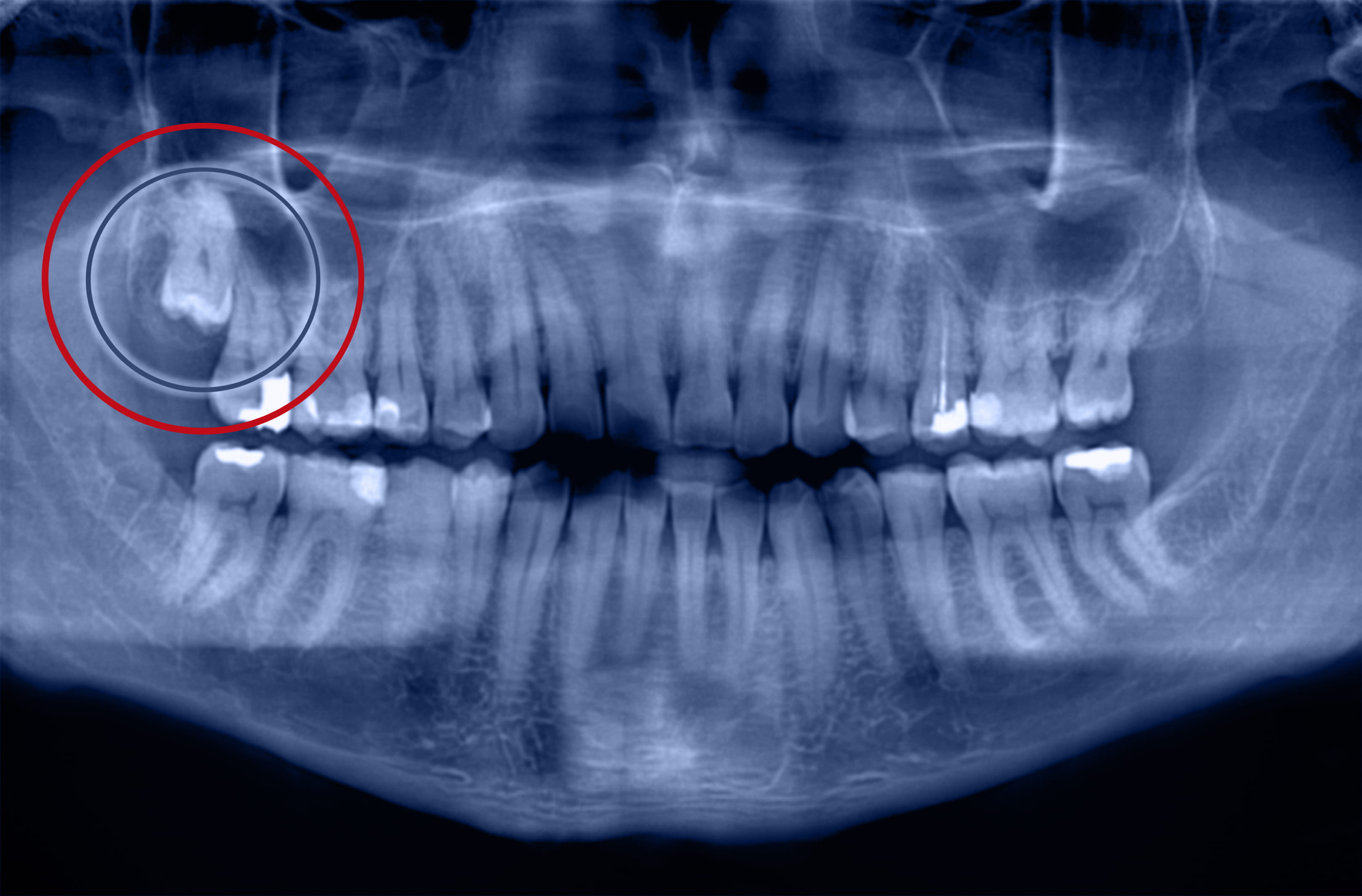 Radiographie panoramique avec les dents de sagesse visibles, dont celle d'en haut à gauche qui est entourée