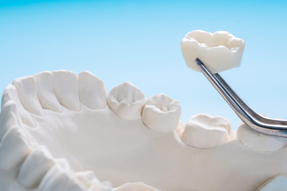 A dental crown being installed on a molar