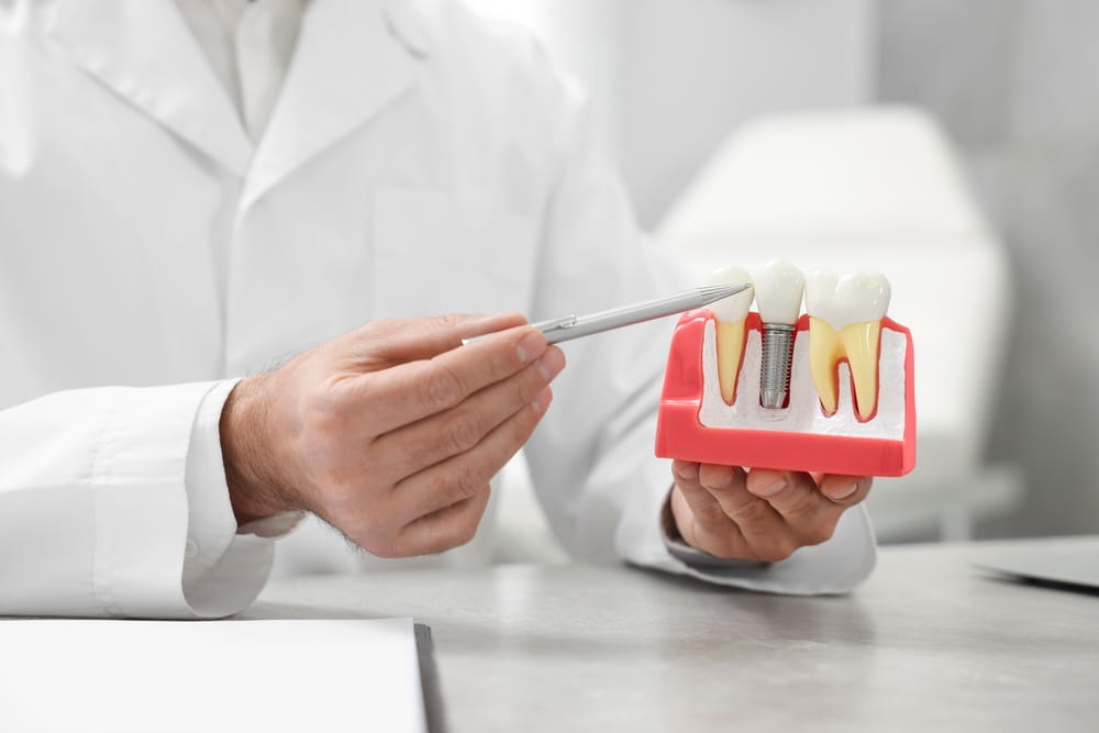 Un dentiste tient un modèle d'implantologie
